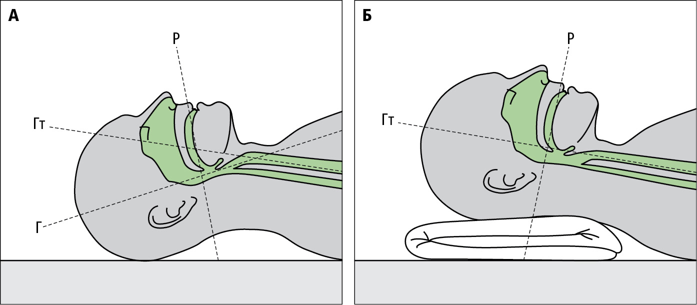 A — схематично представлені довгі осі ротової порожнини (P), горла (Г) та гортані (Гт). Б — Спосіб правильного вкладання голови пацієнта перед виконанням інтубації — піднімання та незначне відгинання 