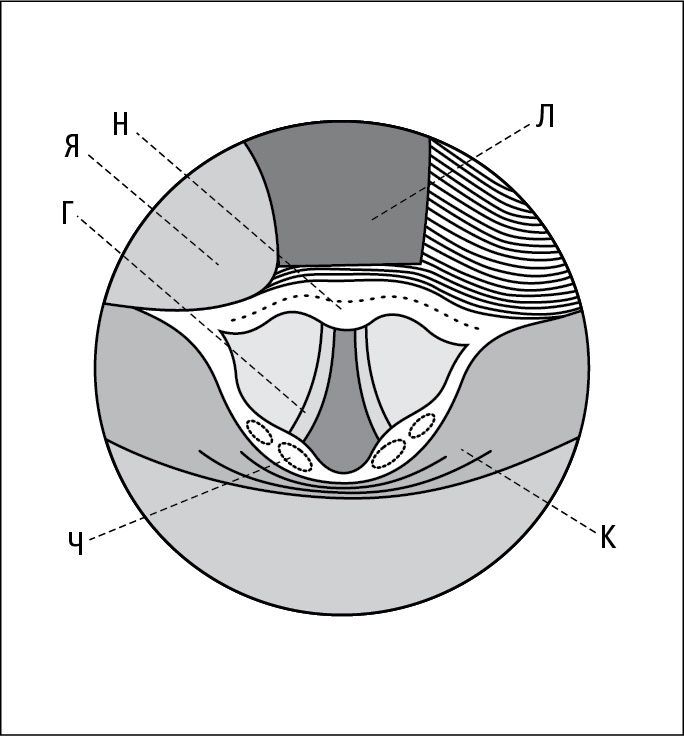  Вигляд входу до гортані при прямій ларингоскопії (що виконується ларингоскопом з викривленим клинком): язик (Я), надгортанник (Н), голосова зв’язка (Г), черпакуватий хрящ (Ч), грушоподібна кишеня (К), клинок ларингоскопу (Л)   