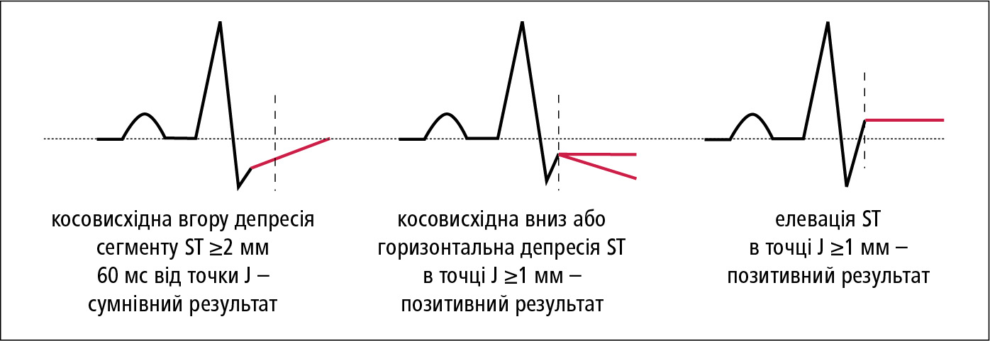 Методи вимірювання депресії сегмента ST на EKГ при навантаженні