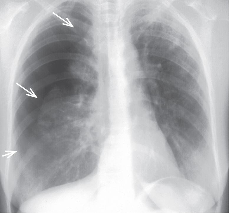  Великий (≥2 см) пневмоторакс (стрілки показують на край легені) 