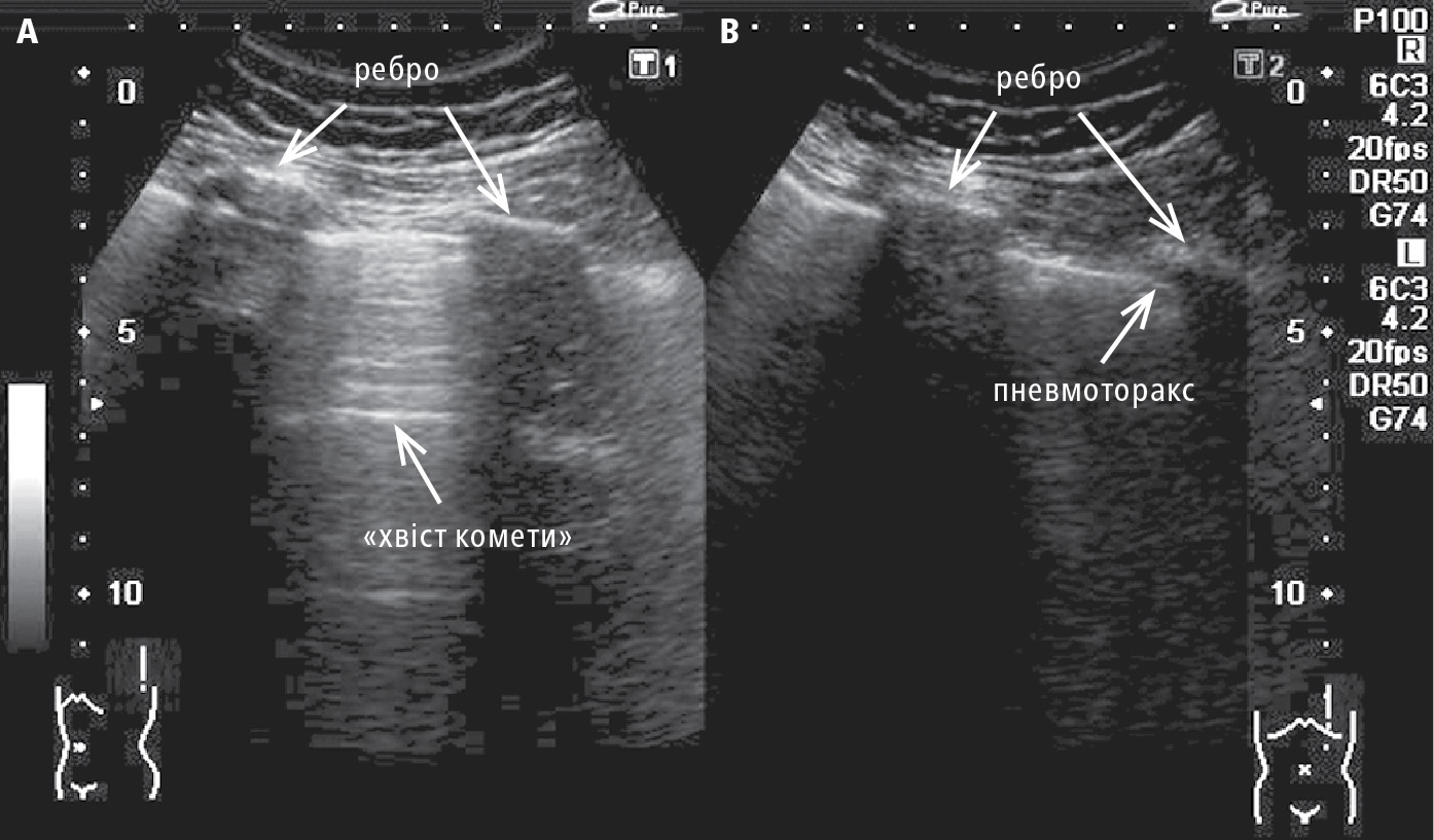 УЗД плеври у здорової особи ( A ) та у пацієнта з пневмотораксом ( B ) 