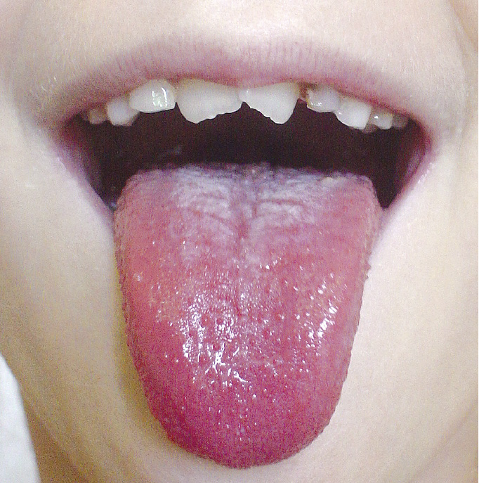 Малиновий язик 