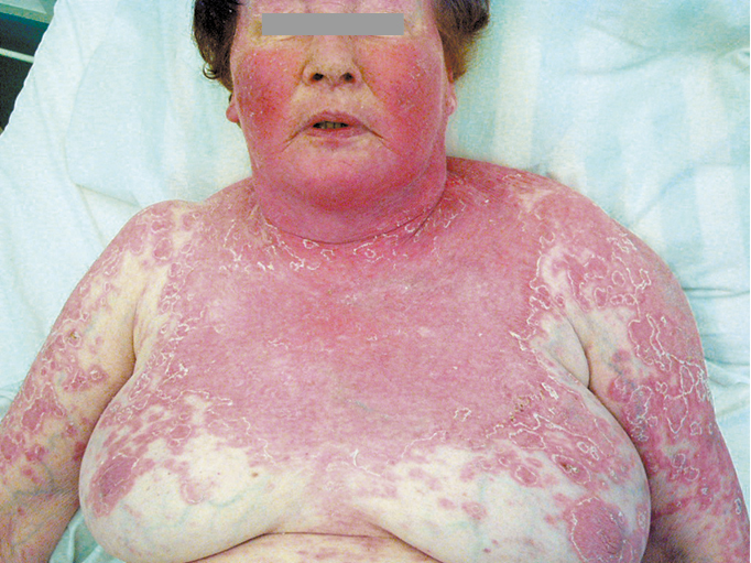 Figure 001_0538.  Systemic lupus erythematosus. Severe cutaneous manifestations following sunlight exposure. 