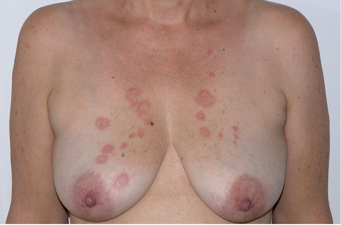 Figure 001_5623.  Subacute cutaneous lupus erythematosus. Circular lesions with erythema and swelling. 