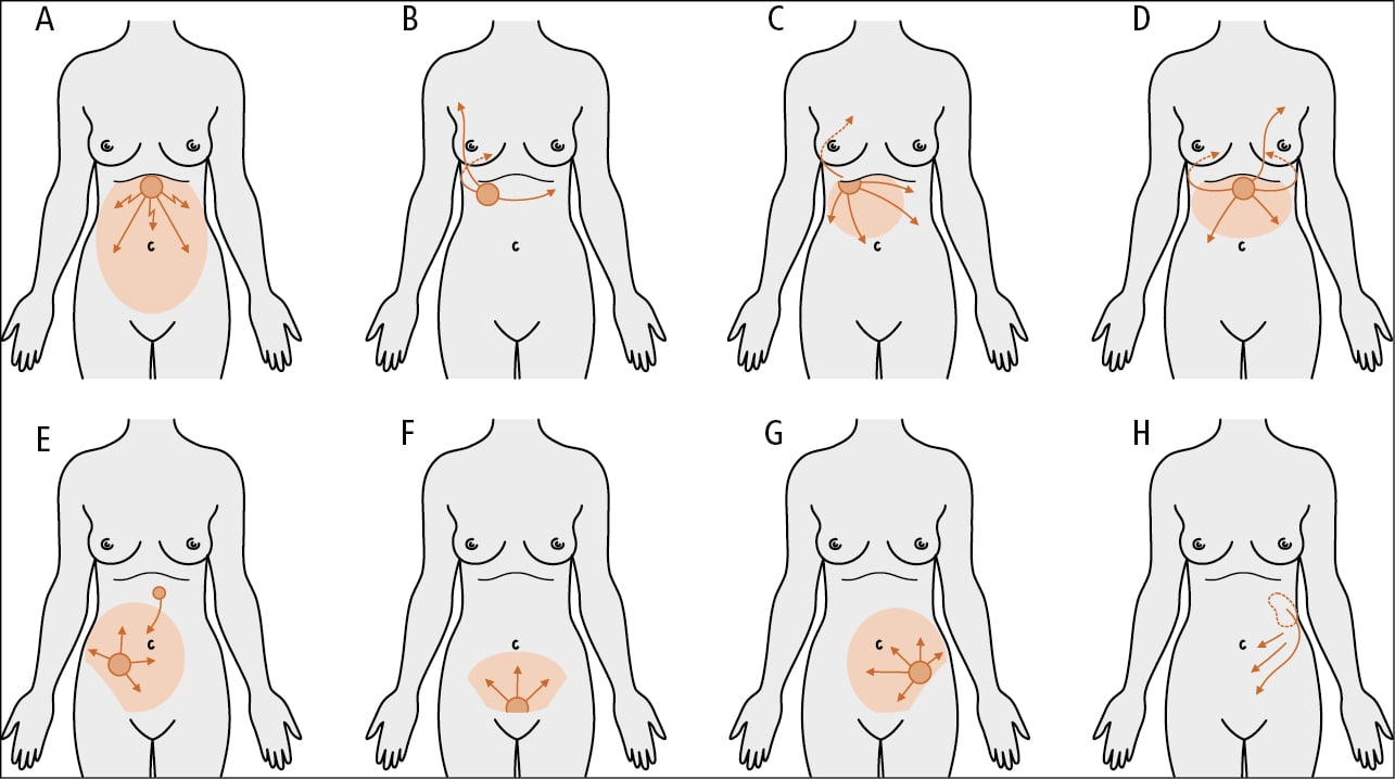 Figure 016_5844.  The character of pain and abdominal guarding in certain conditions associated with adynamic ileus:  A , perforation of a peptic ulcer;  B , biliary colic;  C , acute cholecystitis;  D , acute pancreatitis;  E , appendicitis;  F , adnexitis;  G , perforation of a sigmoid diverticulum;  H , renal colic. 