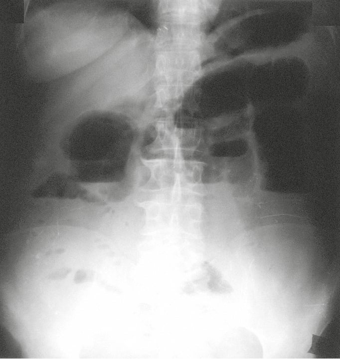 Figure 016_6984.  Plain abdominal radiograph in the standing position. Obstruction of the small intestine with a significant distention of the small intestine and fluid levels visible in a standing position. 