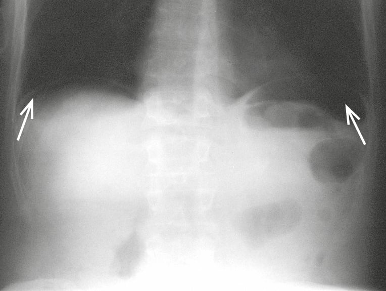 Figure 016_8160.  Plain abdominal radiograph in the standing position including the diaphragm. Perforation of the gastric ulcer with visible free gas (arrows) under both hemidiaphragms. 