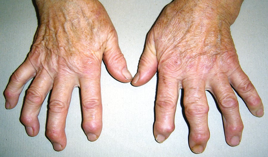 Figure 031_0015.  Osteoarthritis of the hand: Heberden nodes (over the distal interphalangeal joints) involving most fingers of both hands, a Bouchard node (over the proximal interphalangeal joint) on finger III of the left hand. 