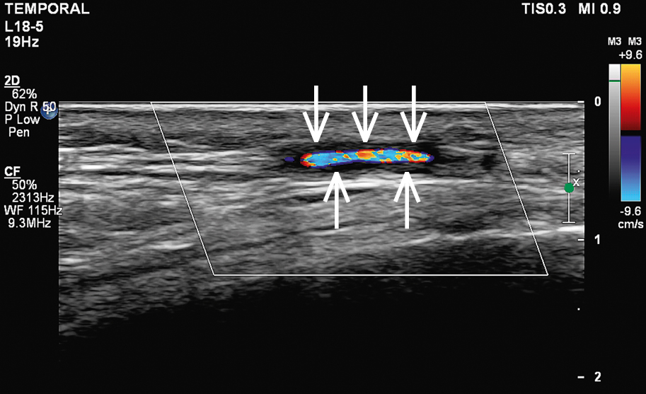 Figure 031_0050.  Doppler ultrasonography of the temporal artery with features of inflammation. A visible halo sign: homogenous hypoechoic wall thickening clearly separated from the arterial lumen seen on transverse and longitudinal views, typically concentric (arrows). 