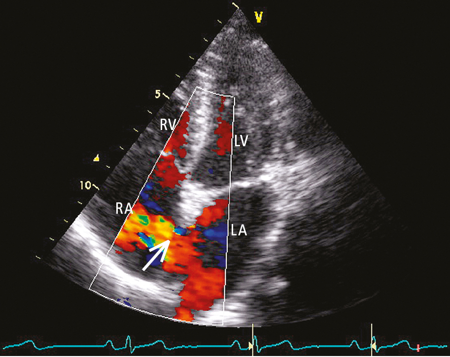 Figure 031_0133.  Transthoracic echocardiography (TTE) (4-chamber view): atrial septal defect (ASD) type II. Color Doppler imaging shows a left-to-right shunt (arrow). LA, left atrium; LV, left ventricle; RA, right atrium; RV, right ventricle. 