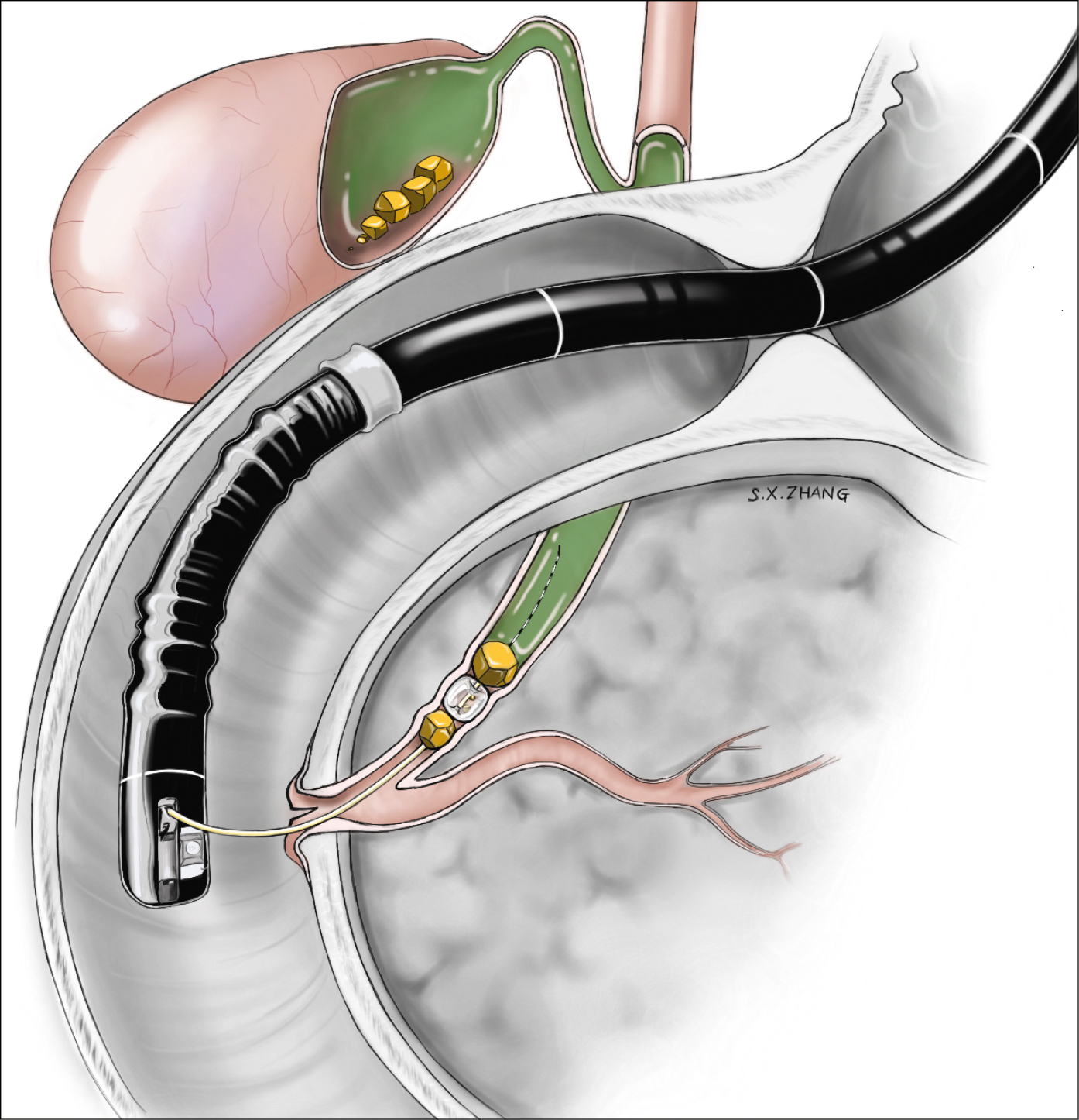 Figure 031_0351.  Endoscopic retrograde cholangiopancreatography (ERCP) with stone extraction.  Illustration courtesy of Dr Shannon Zhang.  