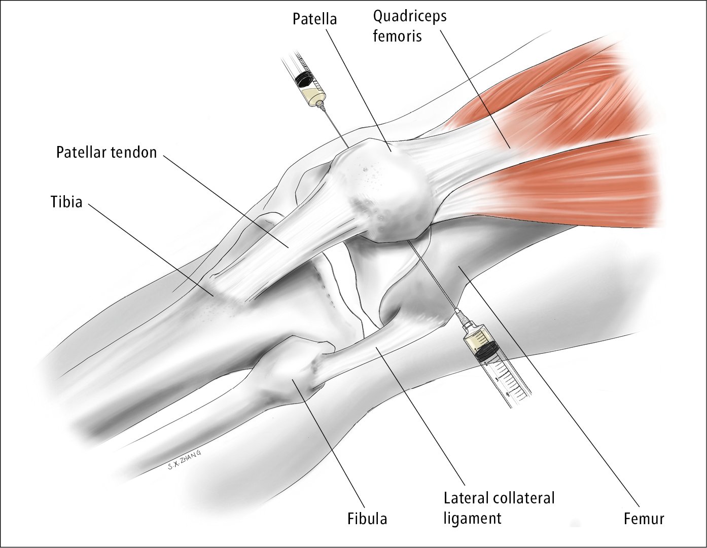 medial approach underneath the mid point of the patella; lateral approach u...