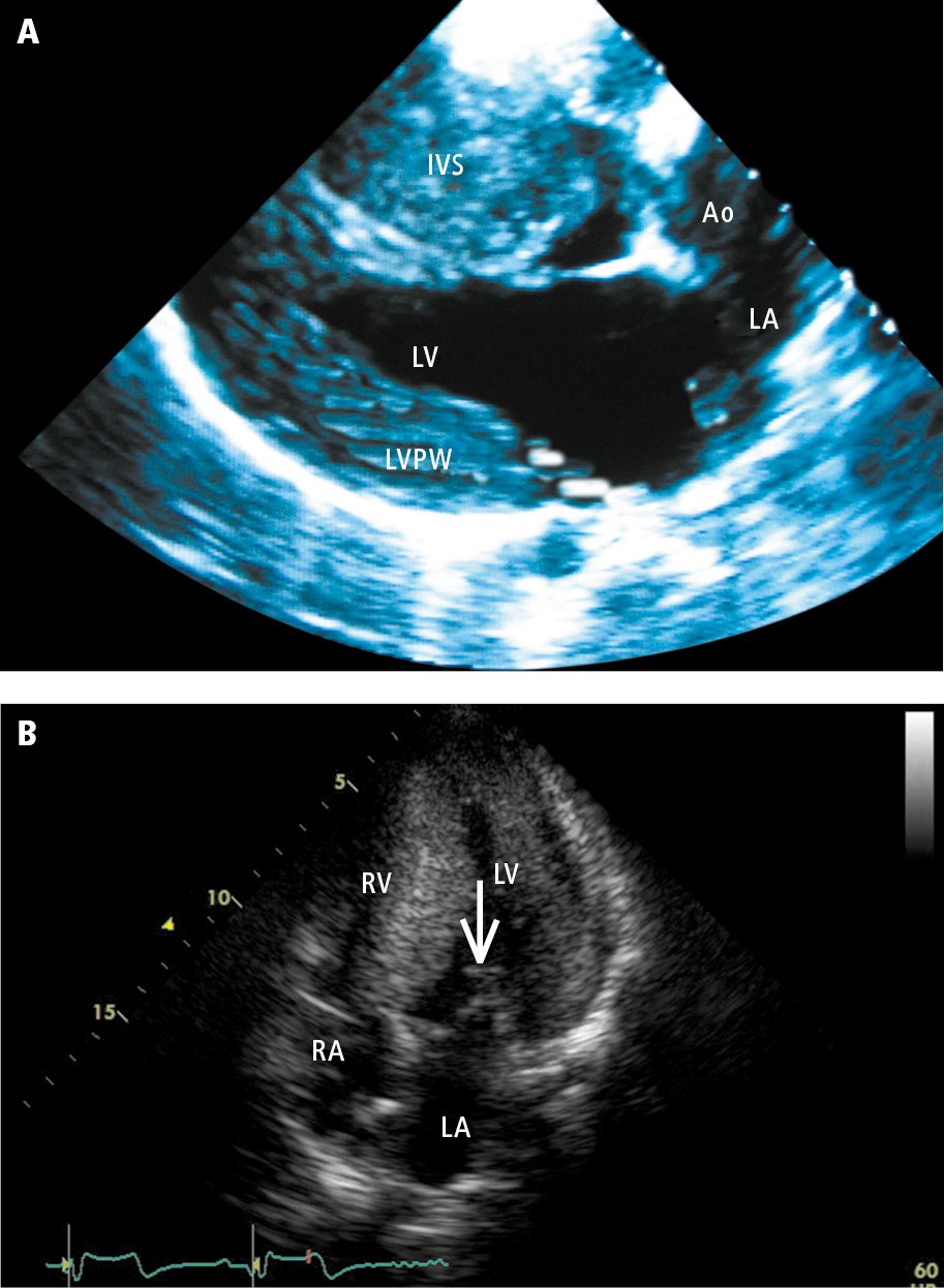 Figure 031_0556.  Echocardiography of patients with hypertrophic cardiomyopathy:   A   (parasternal view), hypertrophy of the left ventricular posterior wall (PW) and interventricular septum (IVS);   B   (apical 4-chamber view), systolic anterior motion (SAM) of the anterior mitral leaflet (arrow)—displacement of the anterior leaflet during systole towards the IVS, which results in the obstruction of the left ventricular outflow tract. Ao, aorta; LA, left atrium; LV, left ventricle; RA, right atrium; RV, right ventricle.  Panel B courtesy of Dr Beata Kuśmierczyk-Droszcz.  