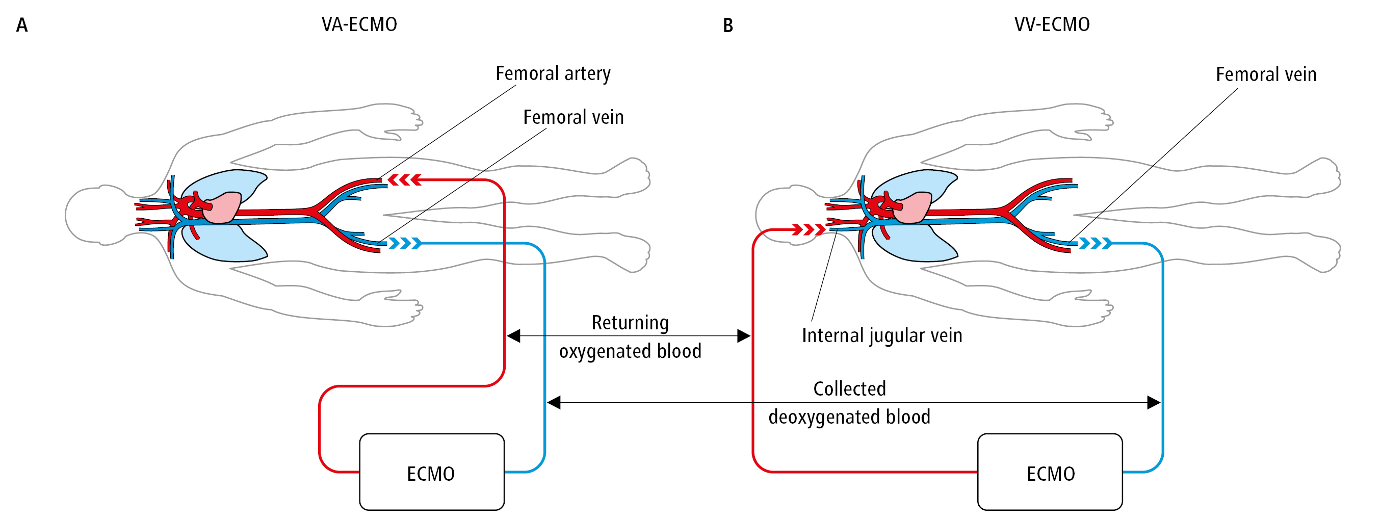 Figure 031_0640.  
Scheme of extracorporeal membrane oxygenation (ECMO).  A , venoarterial system (VA-ECMO).  B , venovenous system (VV-ECMO). 