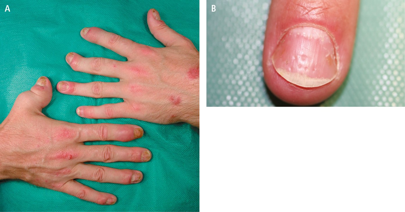 Figure 031_0769.  Psoriatic arthritis.  A , psoriatic lesions on the skin of the outer aspect of both hands, telescopic finger I of the right hand, characteristic involvement of the distal interphalangeal joints, subluxation of the distal phalanx of finger III of the left hand, sausage-shaped finger II of the right hand.  B , nail pitting. 