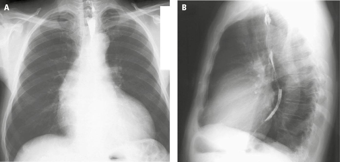 Figure 031_0852.  Posteroanterior (PA;   A  ) and lateral (  B  ) chest radiography: left ventricular hypertrophy and poststenotic dilatation of the ascending aorta (sometimes called the aortic configuration).  Figure courtesy of Dr Jerzy Walecki.  