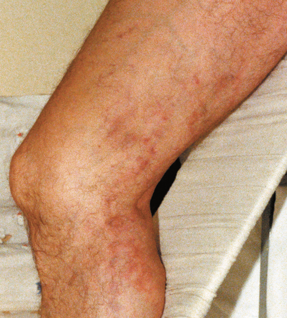 Figure 031_0978.  Varicose phlebitis of the great saphenous vein.  Figure courtesy of Dr Leszek Masłowski.  