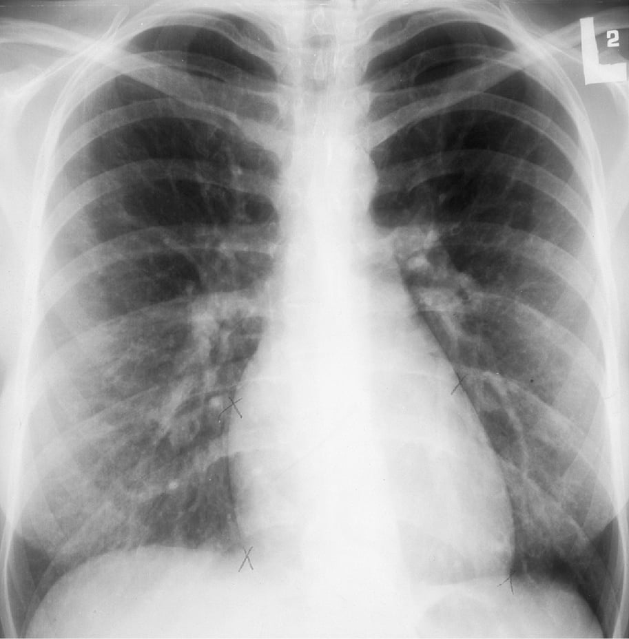 Figure 031_1141.  Chest radiography of a patient with atrial septal defect (ASD) type II: dilated pulmonary arteries, features of increased pulmonary blood flow. 