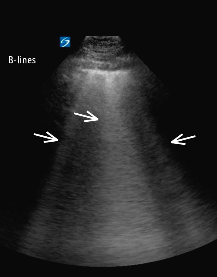 Figure 031_1172.  Multiple B lines (arrows) with confluent B lines (middle arrow). B lines are well-defined, vertical, hyperechoic, dynamic artifacts originating from the pleural line and extending to the bottom of the screen. Patchy or focal B lines is a description based on examination of 8 to 12 lung points. 