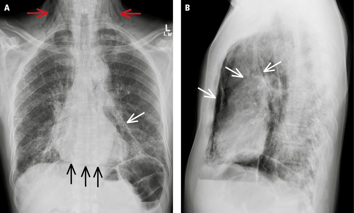Figure 031_1220.  Posteroanterior (PA) chest radiography ( A ) and left lateral view ( B ) demonstrate pneumomediastinum (white arrows) and subcutaneous emphysema (red arrows). A linear radiolucent area (black arrows) linking the hemidiaphragms under the cardiac silhouette represents air in the mediastinal soft tissue (the “continuous diaphragm” sign). 