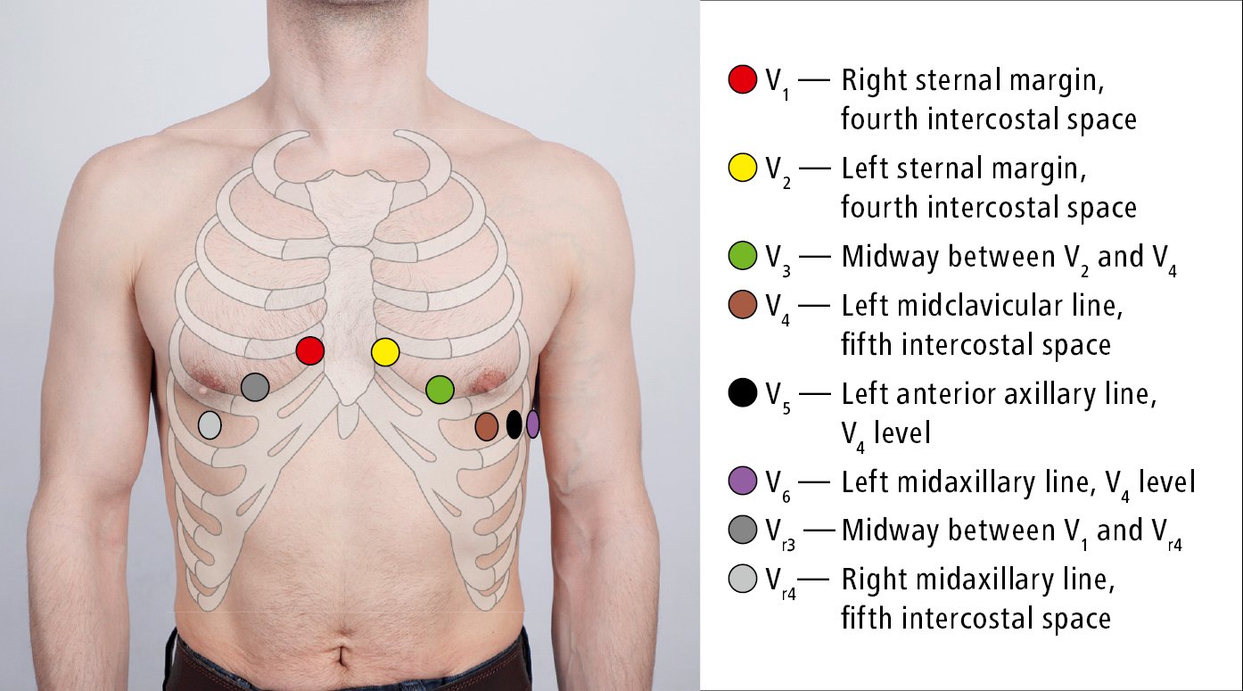 Figure 031_1350.  Placement of electrocardiographic (ECG) leads (recording electrodes). 