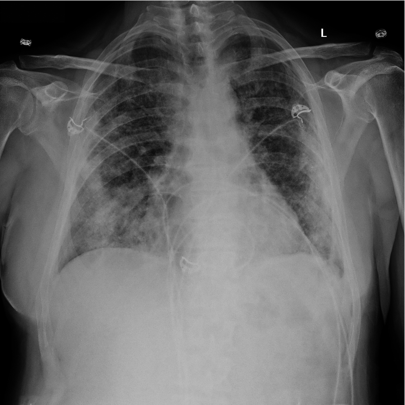 Figure 031_1420.  Anteroposterior (AP) chest radiography. A 65-year-old male patient (case #2) with cough and fever. Diffuse patchy opacities in both lungs, predominantly within the lower lobes and peripherally. 