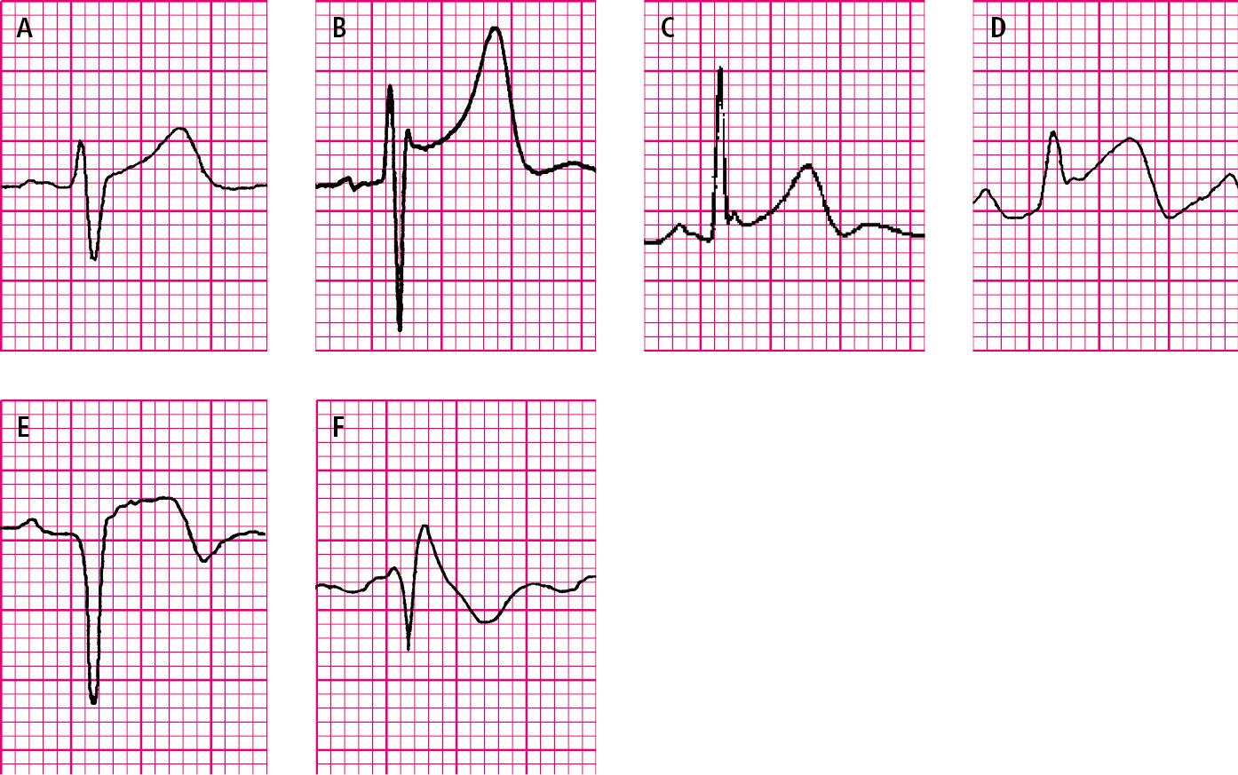 Figure 031_1432.  ST-segment elevation.  A , physiologic, upsloping ST-segment elevation.  B , J-point elevation with concave ST-segment elevation in early ventricular repolarization syndrome.  C , early ventricular repolarization syndrome with a notched terminal R–wave phase.  D , ST-segment elevation during an episode of Prinzmetal angina.  E , ST-segment elevation in acute myocardial infarction (Pardee wave).  F , downsloping (coved) ST-segment elevation in Brugada syndrome. 