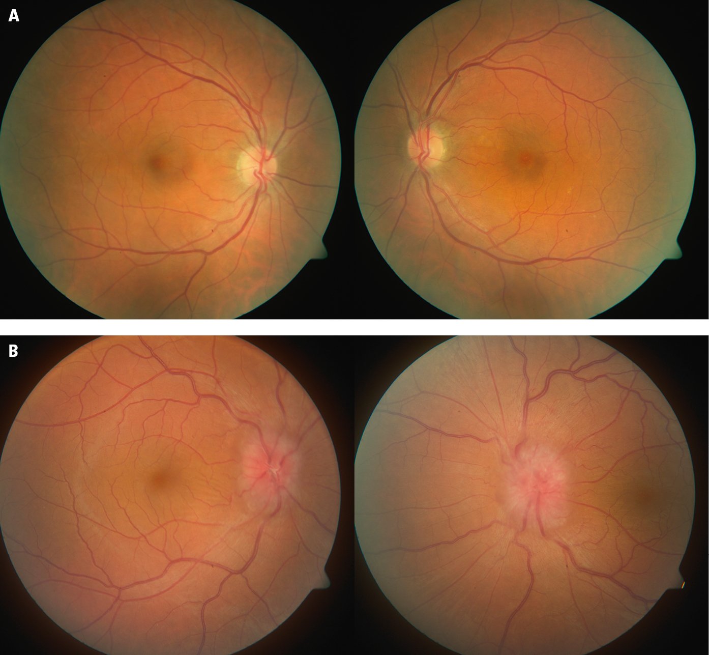 Figure 031_1491.   A , normal looking optic discs.  B , bilateral papilledema. 