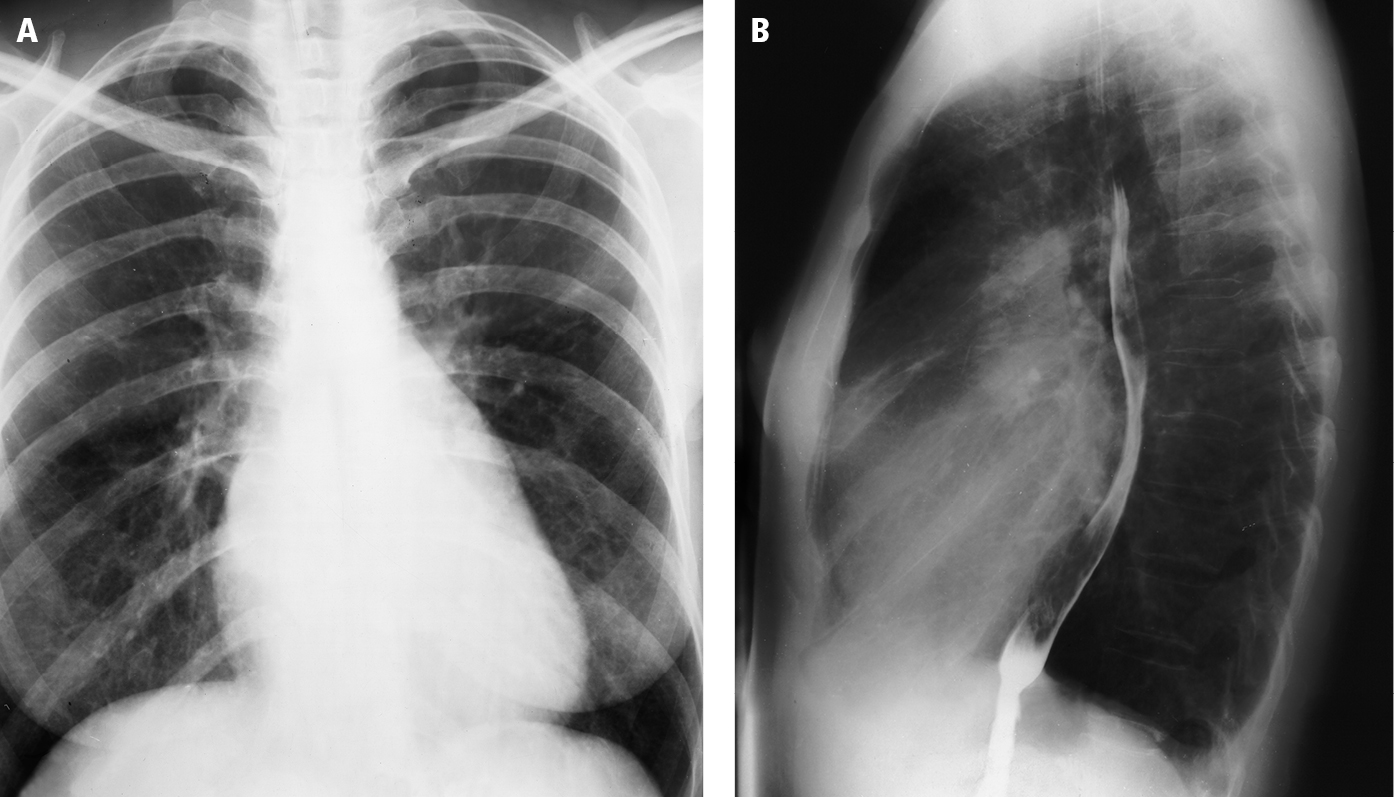Figure 031_1907.  Posteroanterior (PA;   A  ) and lateral (  B  ) chest radiography: so-called mitral configuration of the heart. Dilatation of the main pulmonary artery, right ventricular outflow tract, and left atrium lead to straightening of the left cardiac border (mitralization) in the PA view (sometimes referred to as the mitral configuration of the heart). The lateral view shows posterior displacement of the esophagus by the left atrium.  Figure courtesy of Dr Olgierd Kapuściński.  