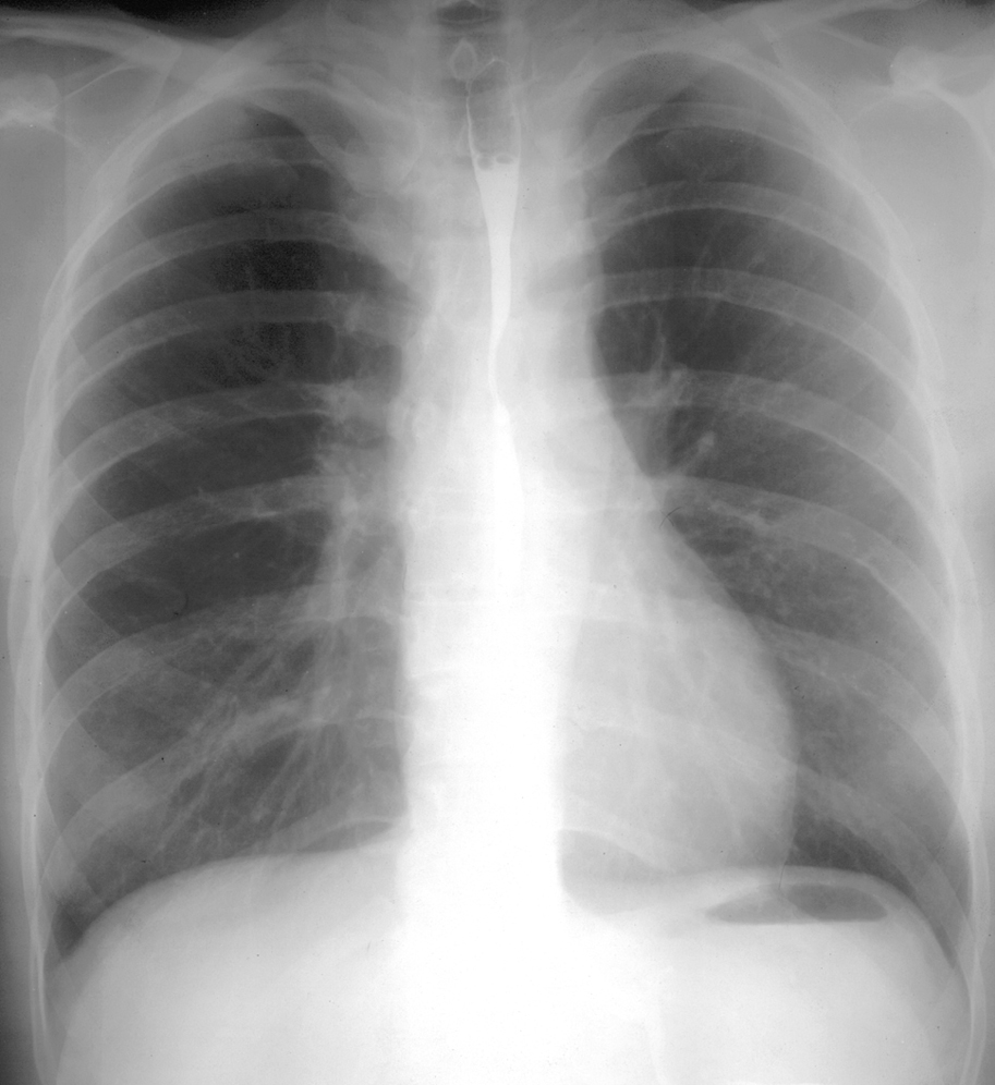 Figure 031_1911.  Chest radiography of a patient with coarctation of the aorta: the so-called figure 3 sign, dilatation of the ascending aorta, notching of the inferior border of the ribs. 