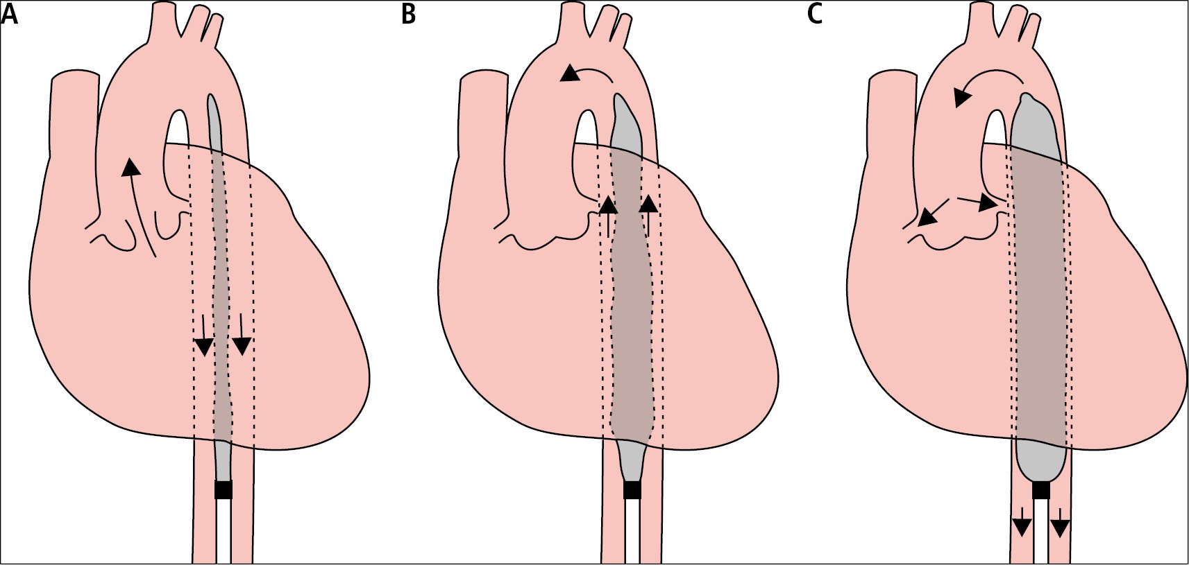 Figure 031_1944.  
The operation principle of an intra-aortic balloon pump (IABP).  A , contraction of the heart, balloon deflated.  B , early heart diastole, starting balloon inflation.  C , late diastolic phase, completion of balloon inflation. 