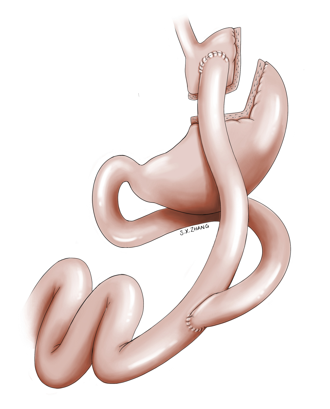 Figure 031_2010.  Roux-en-Y gastric bypass.  Illustration courtesy of Dr Shannon Zhang.  