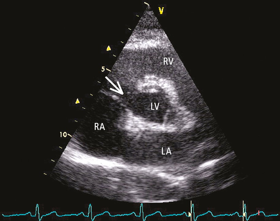 Figure 031_2274.  Transthoracic echocardiography (TTE), parasternal short-axis view: subaortic ventricular septal defect (VSD) (arrow). LA, left atrium; LV, left ventricle; RA, right atrium; RV, right ventricle.  Figure courtesy of Dr Piotr Hoffman.  