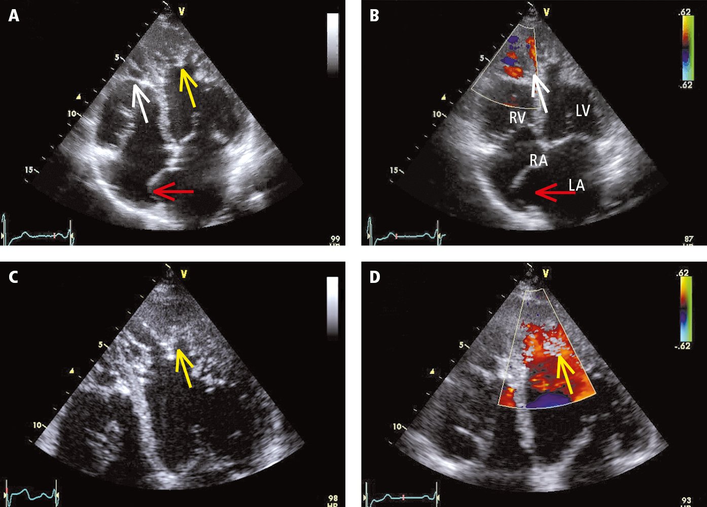 Figure 031_2319.  Transthoracic echocardiography (TTE) of a patient with left ventricular noncompaction (apical 4-chamber view, standard probe placement):  A , 2D imaging;  B , color Doppler examination;  C , enlarged panel A;  D , color Doppler examination. Yellow arrows mark the spongiform structure of the myocardium in the mid and apical segments of the left ventricle (LV). The layer of the abnormal cardiac muscle is more than twice as thick as the healthy compact layer. A healthy apex of the right ventricle (RV) usually has numerous myocardial trabeculae. For this reason, despite the significantly increased trabeculation (white arrow), it is not clear if this finding can be considered abnormal. Color Doppler revealed blood flow penetrating deep into both ventricular apexes, which indicates that tissue in this area is not solid (a solid tissue structure would be typical for apical hypertrophic cardiomyopathy or ventricular cavities filled with thrombi or other masses). The interatrial septum is markedly protruding to the right (red arrow), which meets the diagnostic criteria for atrial septal aneurysm. LA, left atrium; RA, right atrium.  Figure courtesy of Dr Andrzej Gackowski.  