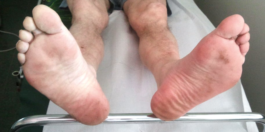 Figure 031_2357.  Foot pallor in an ischemic right leg upon slight elevation.  Figure courtesy of Dr Leszek Masłowski.  