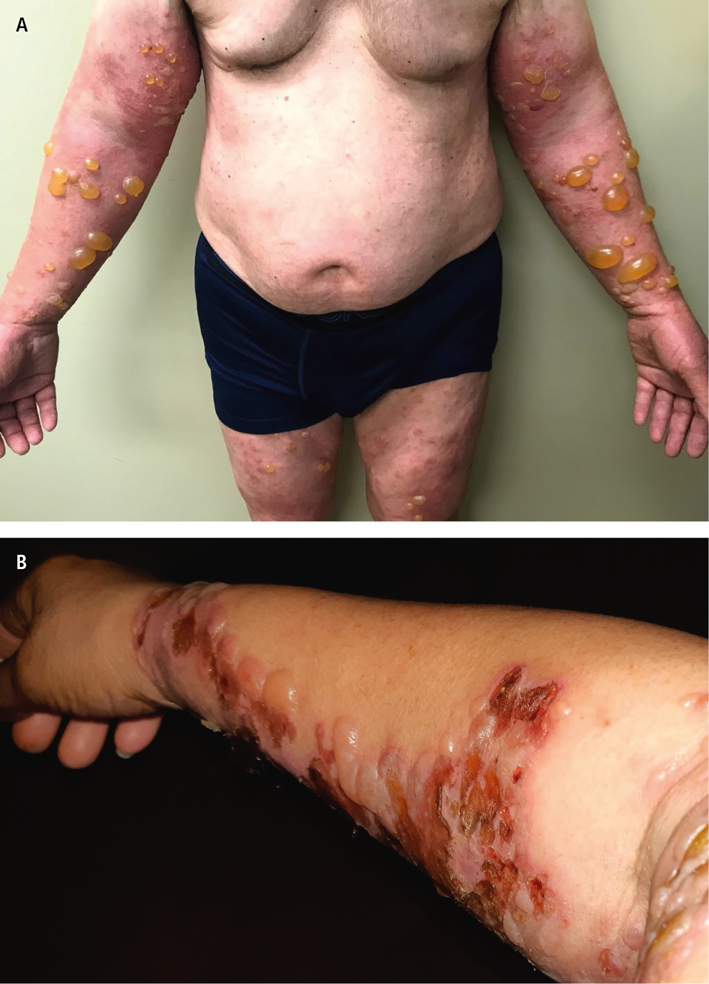 Figure 031_2407.  Tense bullae in bullous pemphigoid.  A , on upper and lower extremities.  B , on the right arm.  Photograph courtesy of Dr Mohannad Abu-Hilal.  