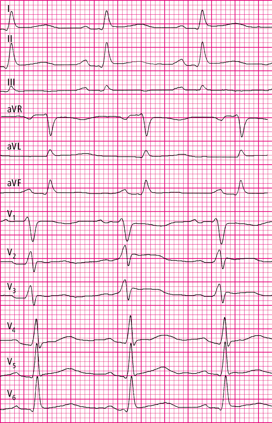 Figure 031_2424.  Echocardiography of a patient with acute pericarditis: PR-segment depressions and ST-segment elevations in all leads (paper speed, 50 mm/s). 