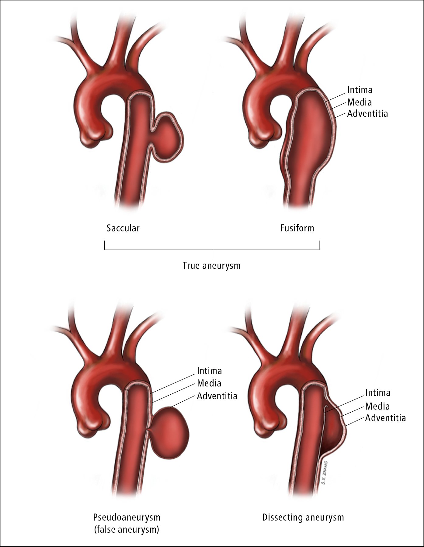 Figure 031_2580.  Different types of aortic aneurysm.  Illustration courtesy of Dr Shannon Zhang.  