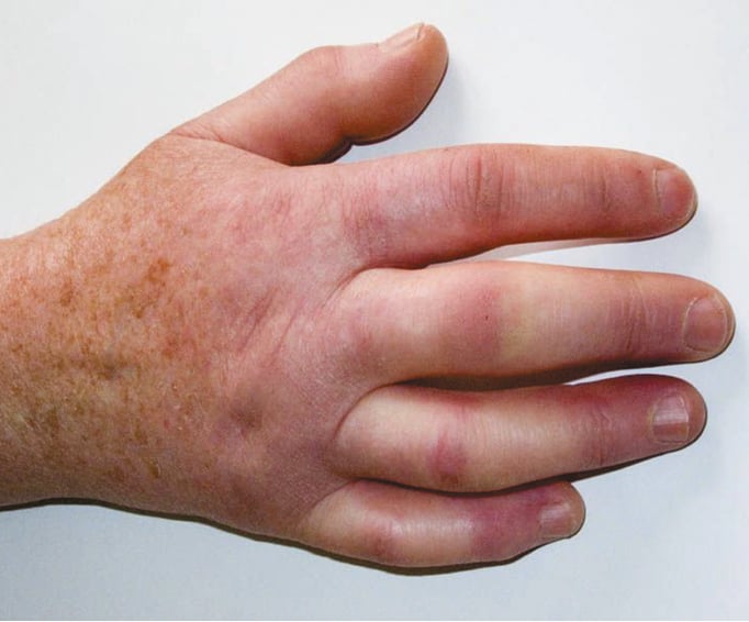 Figure 031_2596.  Systemic sclerosis. The skin on the digits is shiny, hardened, and limits full extension and full flexion of the fingers. 