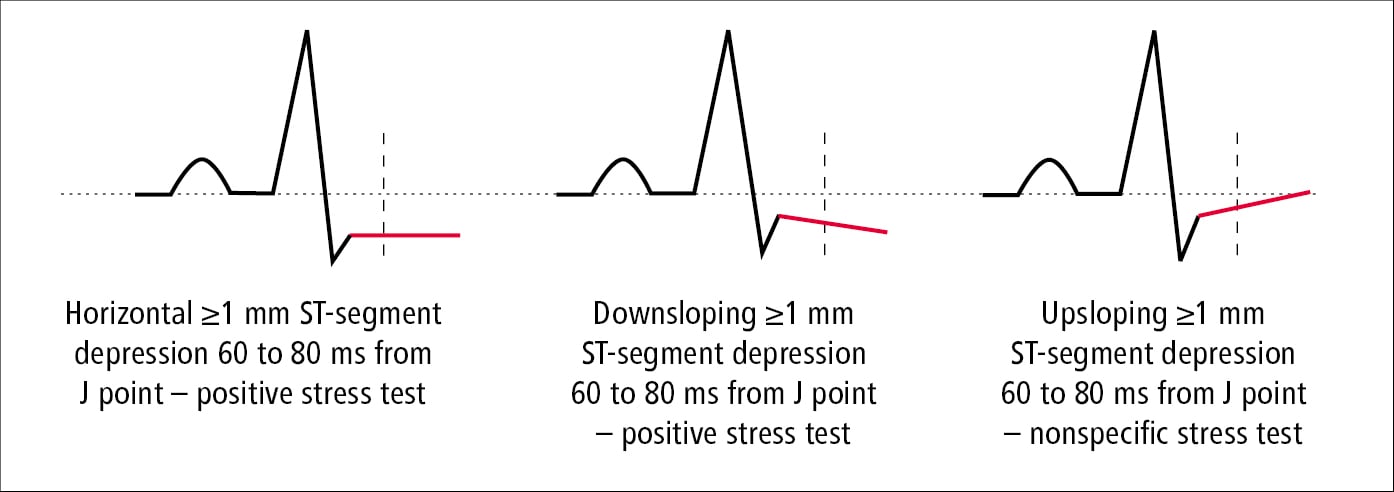 Figure 031_2654.  Measurements of ST-segment depression in an electrocardiographic (ECG) stress test. 