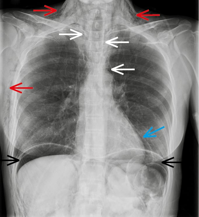 Figure 031_2674.  Presentation of pneumomediastinum and associated complications. A posteroanterior (PA) chest radiograph of a patient with extensive air leakage demonstrates pneumomediastinum (white arrows), subcutaneous emphysema (red arrows), pneumopericardium (blue arrow), and pneumoperitoneum (black arrows). 