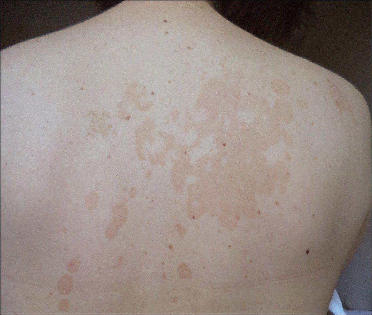 What Is Tinea Versicolor? Symptoms, Causes, Diagnosis, Treatment, and  Prevention