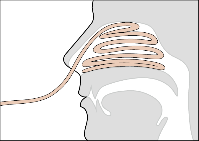 Figure 031_2923.  Anterior nasal packing. 