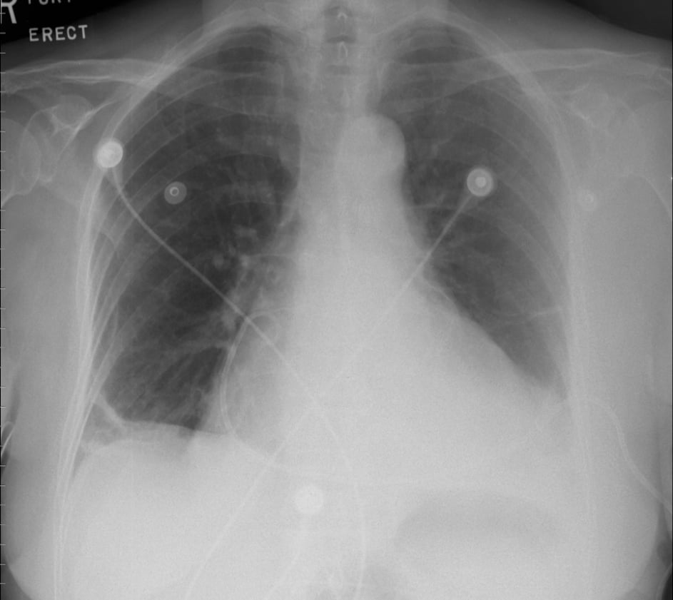 Figure 031_2_0681.  Chest radiography of a patient with cardiac tamponade after pericardiocentesis.  Figure courtesy of Dr Craig Ainsworth.  