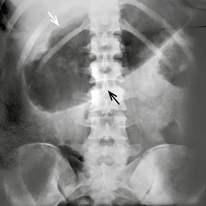 Figure 031_2_0758.  Toxic megacolon seen on a plain abdominal radiograph. The transverse colon is 11 cm in diameter in the midline (arrow). 