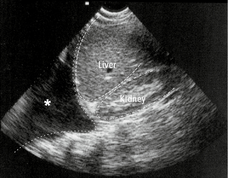 Figure 031_2_4819.  Ultrasonography of the right hypochondrium visualizing a pleural effusion (asterisk). 