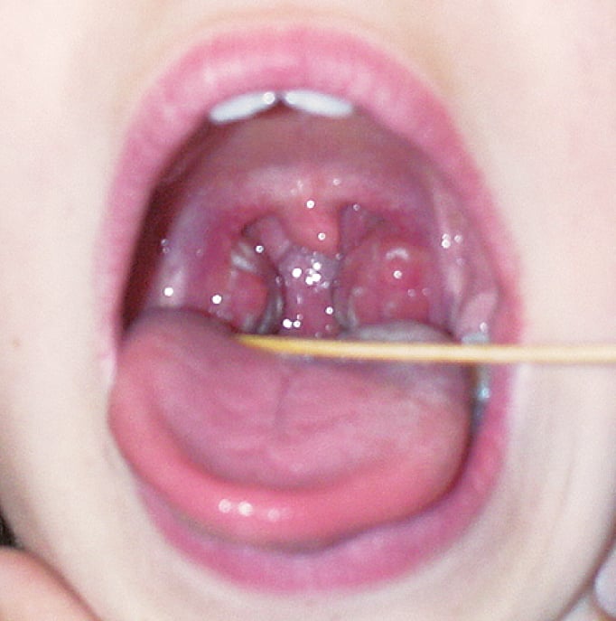 Figure 031_2_8934.  Streptococcal pharyngitis. 