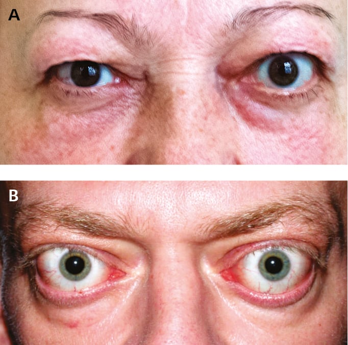 Figure 031_2_9057.  Thyroid-associated orbitopathy.  A , mild orbitopathy (eyelid retraction, mild right eye proptosis without other symptoms affecting soft tissues).  B , overt orbitopathy.  Figure courtesy of Dr Ewa Bar-Andziak.  