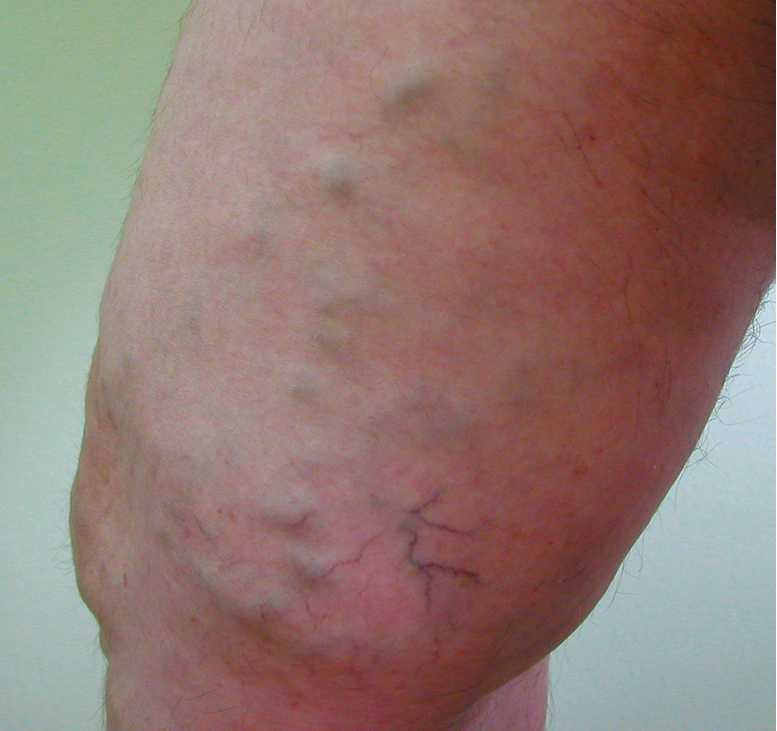 Figure 031_2_9293.  Varicose veins of the great saphenous vein.  Figure courtesy of Dr Leszek Masłowski.  
