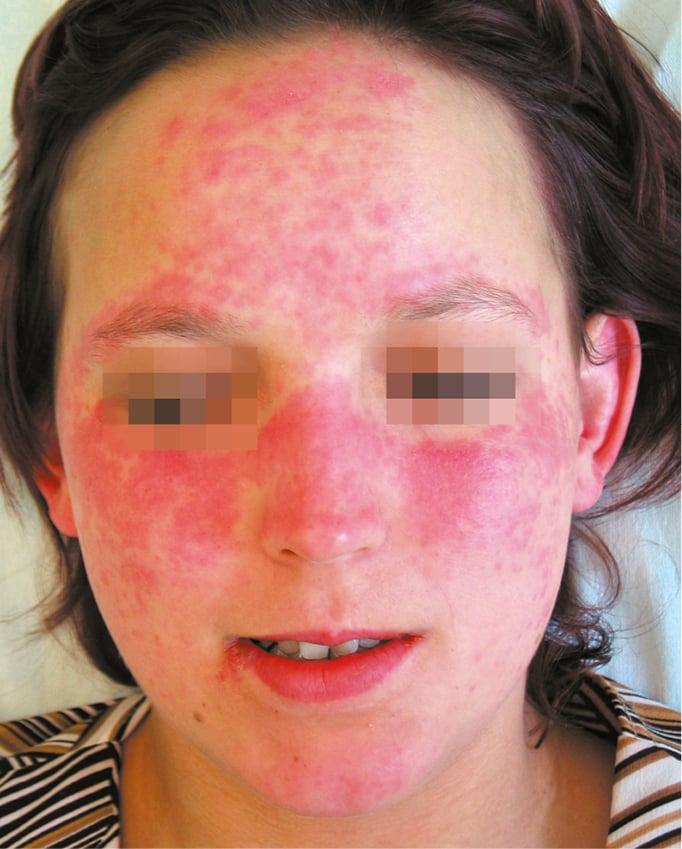 Figure 031_2_9730. Systemic lupus erythematosus. Typical  &amp;#8220;butterfly&amp;#8221; rash. - McMaster Textbook of Internal Medicine